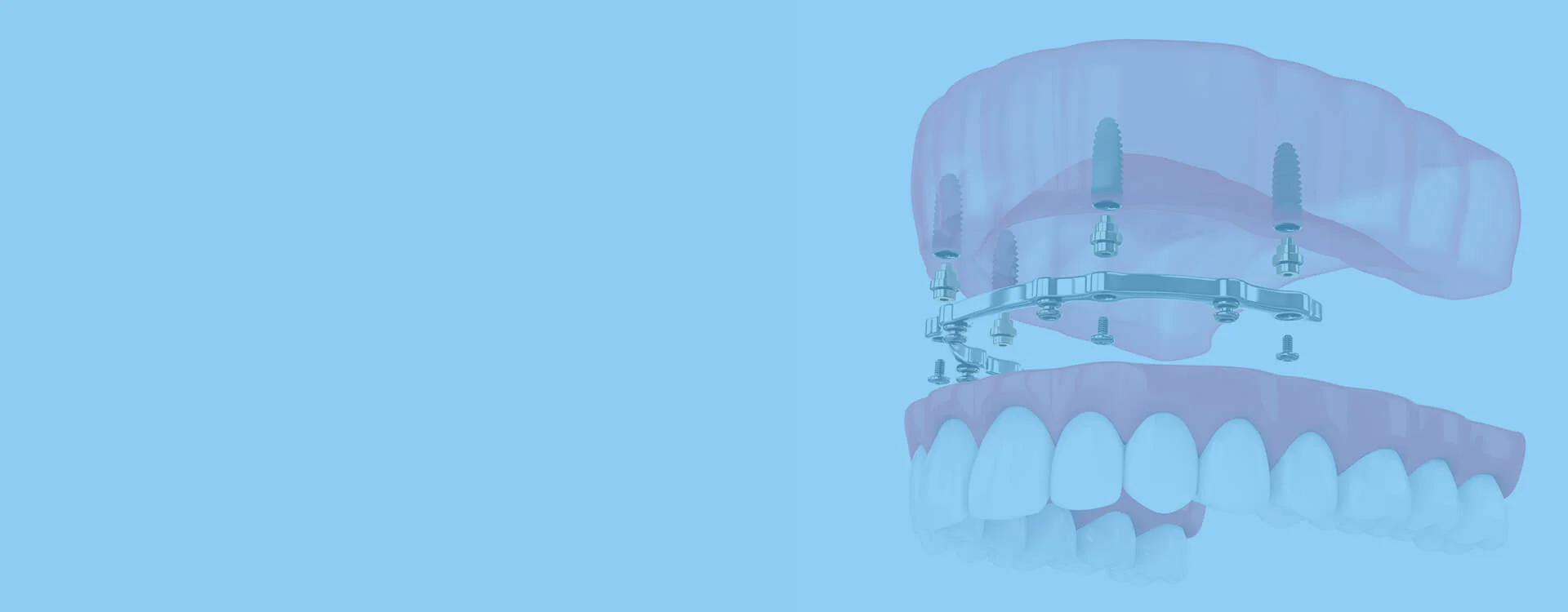 Transform Your Life with All-on-4 Implants