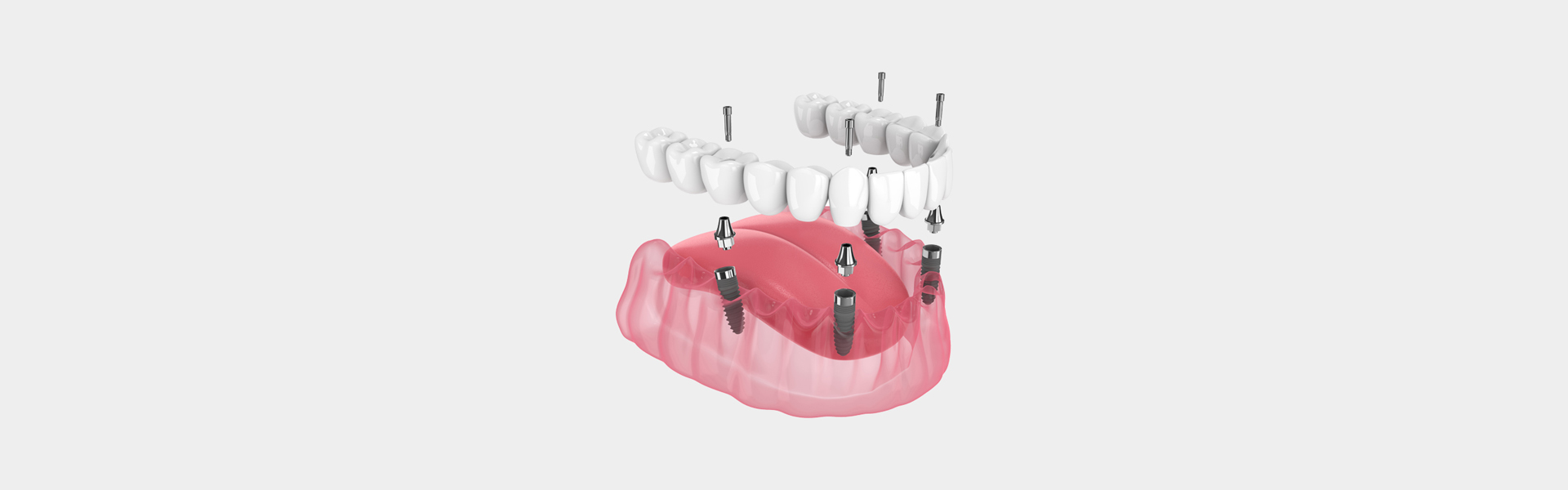 A New Solution for Full Mouth Reconstruction: All-on-4 Implants
