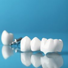 Why Same-Day Crowns Are the Future of Dental Restorations?