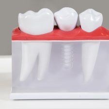 Get Your Dream Smile With Dental Implants in a Day