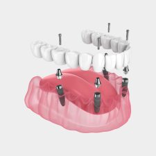 Healing After a Single Tooth Implant: What You Should Know
