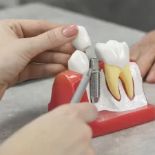 Advantages of Getting Implant-Supported Dentures in Burlington
