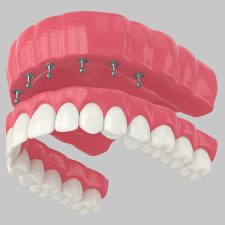 All-on-X Dental Implants vs. Traditional Implants: Which One Is Right for You?