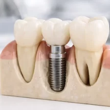 Did You Know Dental Implants Are a Close Option to Natural Teeth?