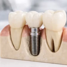 What Makes Dental Implants in Burlington More Comfortable Than Ever Before?